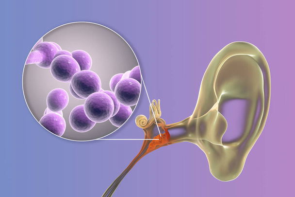 Otite moyenne suppurative chronique causée par des champignons Candida, maladie inflammatoire de l'oreille moyenne, illustration 3D - Photo, image