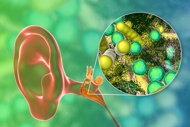 Otitis media, una enfermedad inflamatoria del oído medio, y vista de cerca de las bacterias, el agente causal de la otitis, ilustración 3D - Foto, imagen