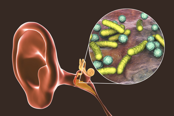 Otitis media, gyulladásos betegség a középfül, és közelkép a baktériumok, a kórokozó otitis, 3D illusztráció - Fotó, kép