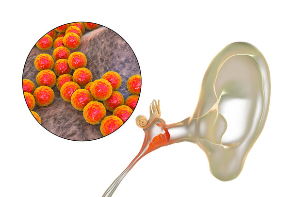 Otite media causata da batteri Staphylococcus aureus, una malattia infiammatoria dell'orecchio medio, illustrazione 3D - Foto, immagini
