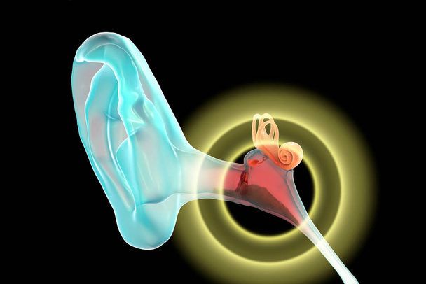 Otitis media, enfermedad inflamatoria del oído medio, ilustración 3D - Foto, imagen