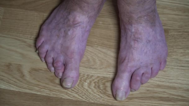 Detailní záběr starých nemocných ženských nohou se zkřivenými prsty a dlouhými děsivými nehty. Starší žena je nahá s bolavýma nohama. Velké velmi staré nohy důchodce neostříhané žluté hrozné nehty - Záběry, video