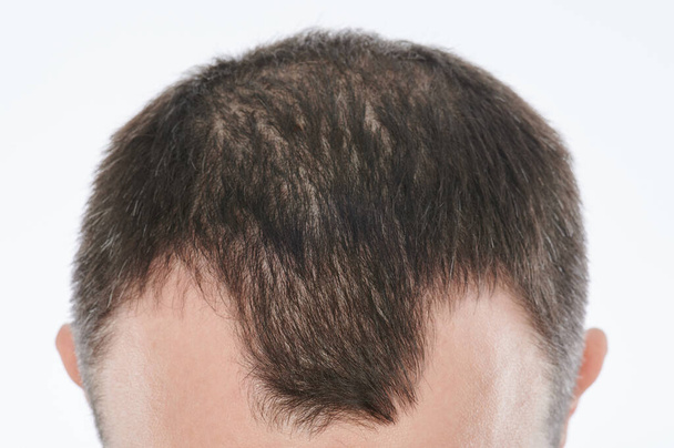 Homem perdendo cabelo na cabeça close-up isolado no fundo branco - Foto, Imagem