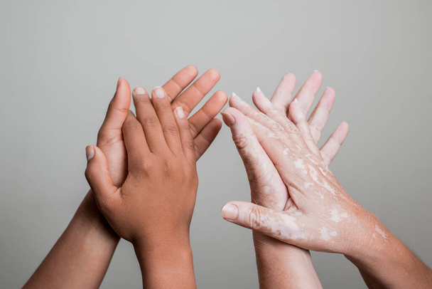A black hand and senior hand with vitiligo clapping - Fotoğraf, Görsel
