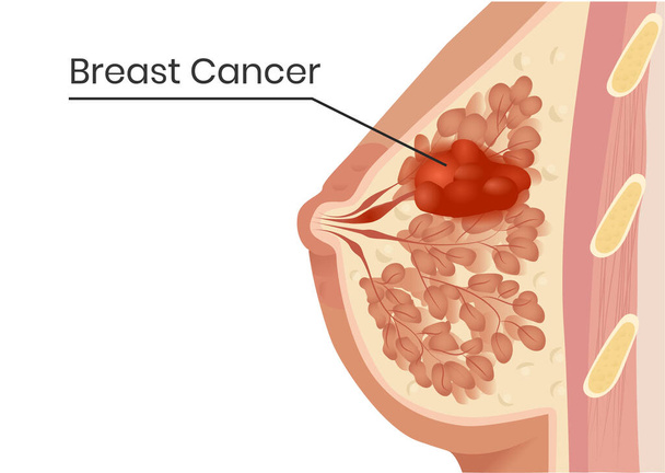 Brustkrebs. Vektorillustration des Lobularkarzinoms mit minimalen Veränderungen der Kanäle - Vektor, Bild
