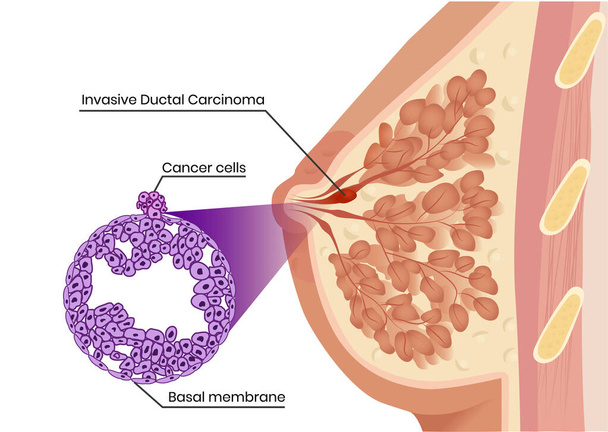 Инвазивная карцинома протока и патология, изображающая пиратство раковых клеток базальной мембраны - Вектор,изображение