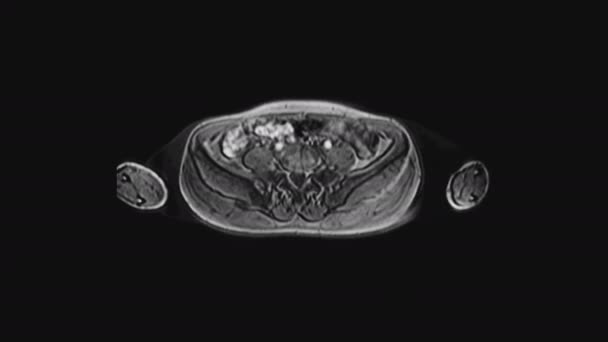 MRI of the female pelvic organs, abdominal cavity, gastrointestinal tract and bladder - Footage, Video