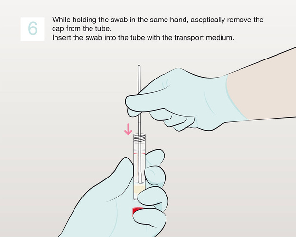 While holding the swab in the same hand, aseptically remove the cap from the tube. Insert the swab into the tube with the transport medium. Step 6 - Vector, Image