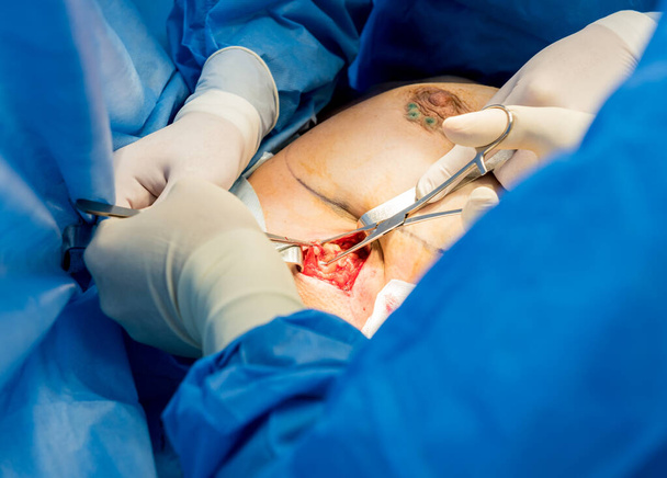 Surgery to remove the breast and replace it with an implant. - Foto, Imagen