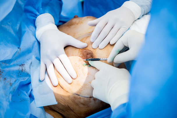 Surgery to remove the breast and replace it with an implant. - Φωτογραφία, εικόνα