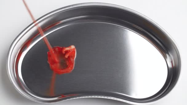Shooting of a bloodied wisdom tooth in a kidney tray - Footage, Video