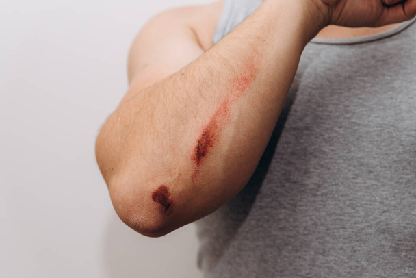 Grandi abrasioni sull'avambraccio di un uomo dopo una caduta. - Foto, immagini