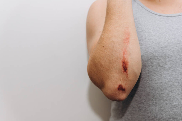 Grandi abrasioni sull'avambraccio di un uomo dopo una caduta. - Foto, immagini