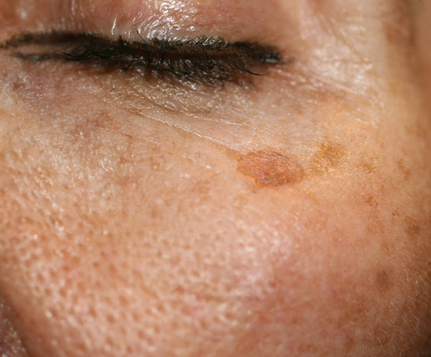 Bruine vlek op de huid van het gezicht. Pigmentatie op de huid - Foto, afbeelding
