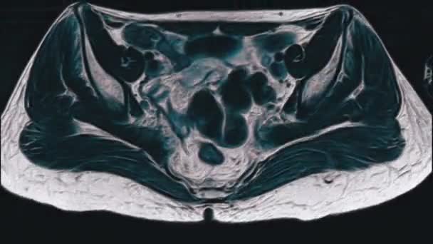 Resonancia magnética de color voluminoso de los órganos pélvicos femeninos, cavidad abdominal, tracto gastrointestinal y vejiga - Metraje, vídeo