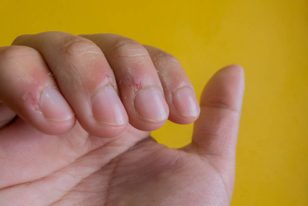vingers met slecht verzorgde en beschadigde nagels sommige in focus, van de hand van een man met gedefocuste gele achtergrond - Foto, afbeelding