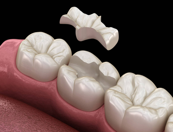 Inlay Keramikkrone Fixierung über den Zahn. Medizinisch genaue 3D-Abbildung der Behandlung menschlicher Zähne - Foto, Bild