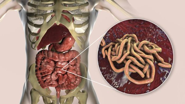 Parasitic worms in human small intestine, 3D illustration. Ascaris lumbricoides and other round worms - Photo, Image