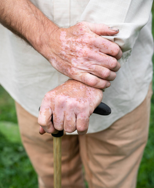 Nahaufnahme männlicher Hände mit Vitiligo-Pigmenten im Freien - Foto, Bild
