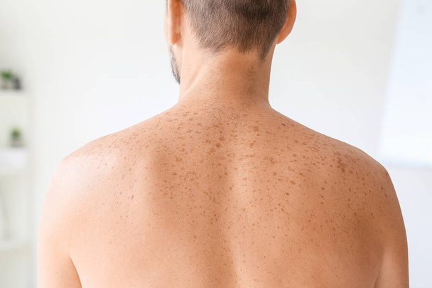 Man with freckles at dermatologist's office - Foto, Imagem