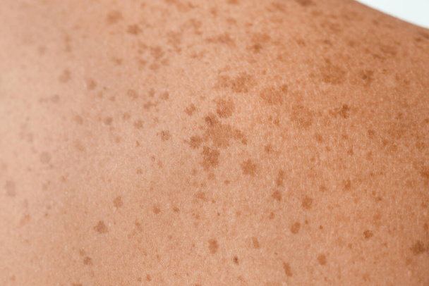 Human skin with freckles, closeup - Foto, imagen