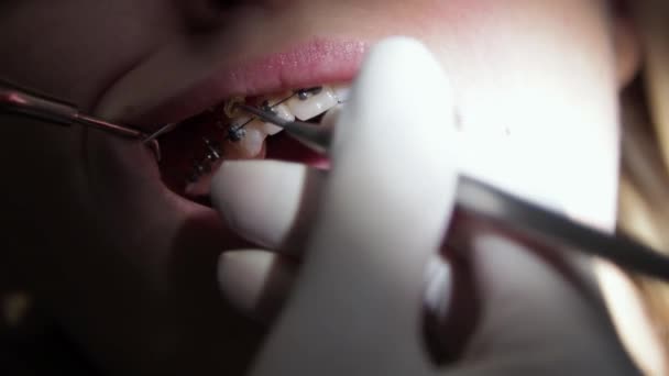 Νεαρή γυναίκα οδοντίατρος Αντικατάσταση ελαστικών ιμάντων σε τιράντες Στόμα close-up - Πλάνα, βίντεο