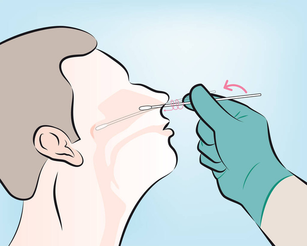 Schritt 4: Den Abstrich vorsichtig in das Nasenloch einführen. Halten Sie den Abstrich in der Nähe des Nasenscheidebodens, während Sie den Abstrich sanft in den Post-Nasopharynx schieben. - Vektor, Bild