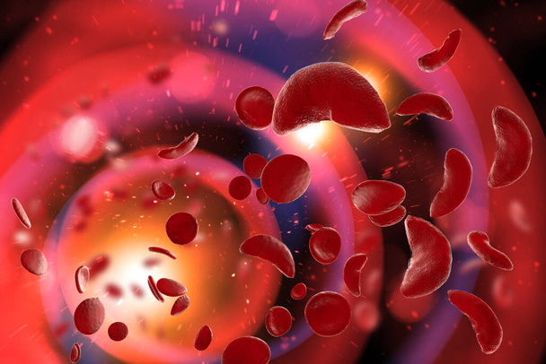 Niedokrwistość sierpowatokrwinkowa (SCD) komórki krwi 3D ilustracja - Zdjęcie, obraz