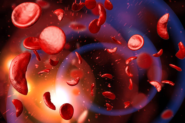 Ilustração 3D das células sanguíneas da doença da anemia falciforme (DF) - Foto, Imagem