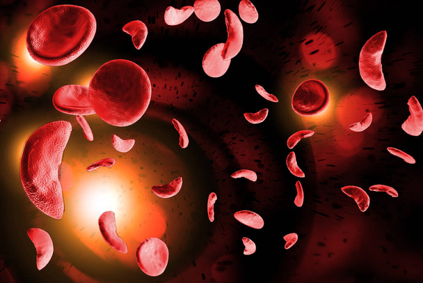 Anemia falciforme (anemia drepanocítica) células sanguíneas ilustración 3D - Foto, imagen