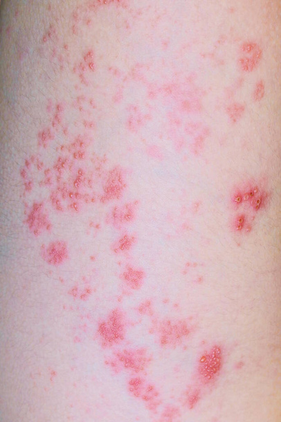 Сыпь с волдырями при вирусных заболеваниях Черепица на ноге двенадцатилетнего бо - Фото, изображение