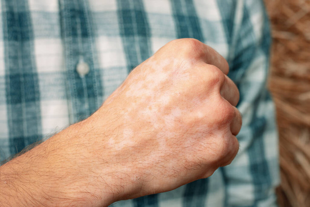 Muž s vitiligem ukazuje zaťatou ruku v pěst.. - Fotografie, Obrázek