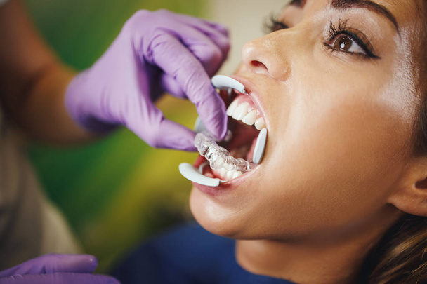 Η φωτογραφία ενός οδοντιάτρου δείχνει αόρατο οδοντίατρο στα δόντια μιας νεαρής γυναίκας. Βάζει invisalign αφαιρούμενα σιδεράκια. - Φωτογραφία, εικόνα