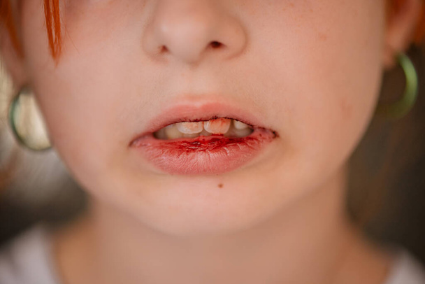 Niña con el labio roto. Una chica con el labio roto. Adolescente herida su labio - Foto, Imagen