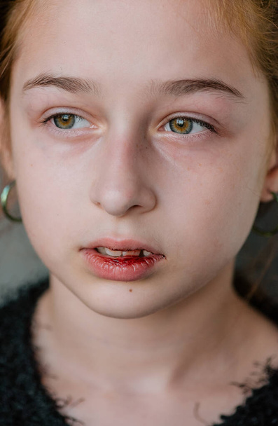 Egy kislány törött szájjal. Törött ajkú lány. A tinédzser megütötte az ajkát - Fotó, kép