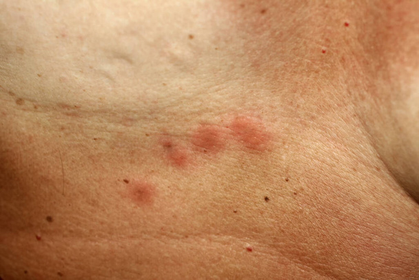 Τσιμπήματα κουνουπιών στο δέρμα κάτω από το στήθος - Φωτογραφία, εικόνα