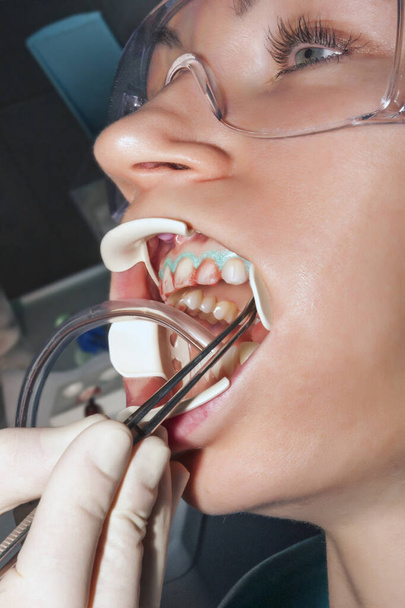Στοματική υγιεινή στο οδοντιατρικό γραφείο, γιατρός οδοντίατρος εκτελεί λεύκανση δοντιών χρησιμοποιώντας ιατρικά εργαλεία για την οδοντιατρική περίθαλψη - Φωτογραφία, εικόνα