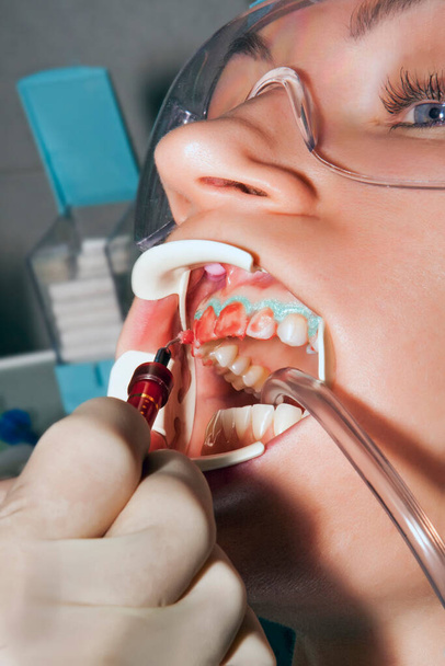 Гигиена полости рта в стоматологическом кабинете, врач-стоматолог проводит отбеливание зубов с помощью медицинских инструментов для ухода за зубами - Фото, изображение
