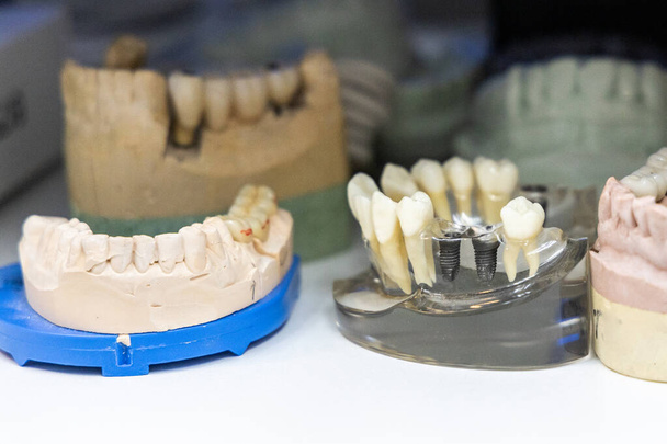 Vari modelli di calco dentale. Focus sul modello cast con impianti dentali a destra - Foto, immagini