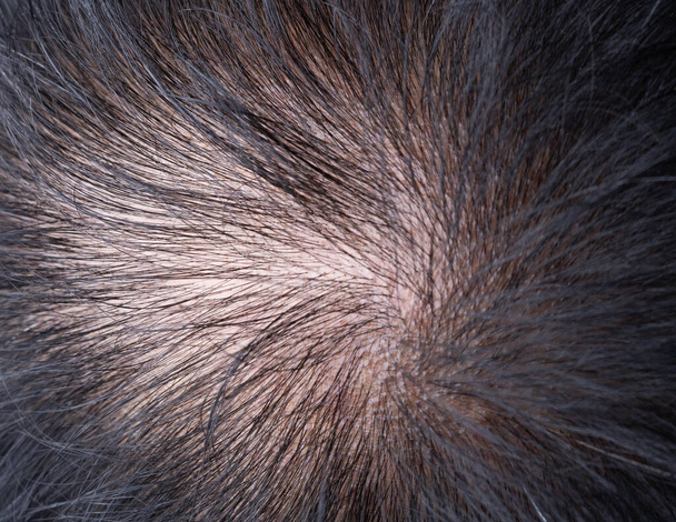 Голова гладкої облисіння, стан шкіри волосся крупним планом показують на екрані монітора. Концепція перевірки контролю падіння волосся
 - Фото, зображення