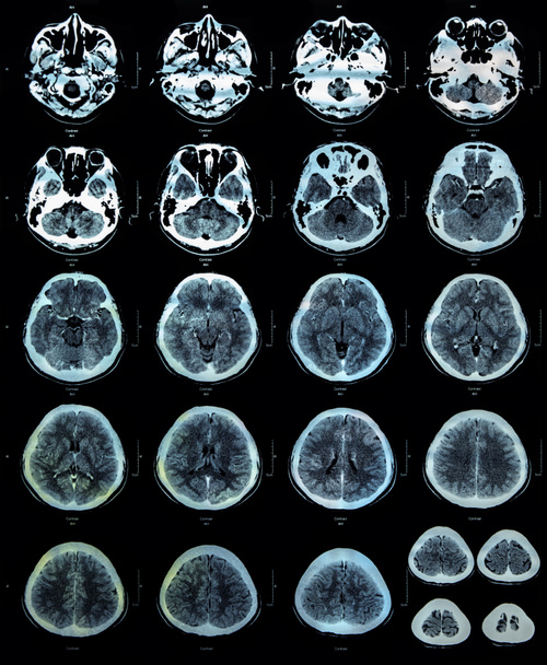 rezonans magnetyczny kolorowy (MRI) mózgu. - Zdjęcie, obraz