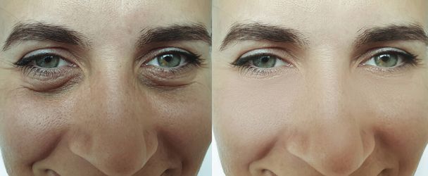 zmarszczki twarzy kobiety przed i po leczeniu - Zdjęcie, obraz