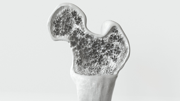 Osteoporosis etapa 2 de 3 - 3D renderizado - Foto, Imagen