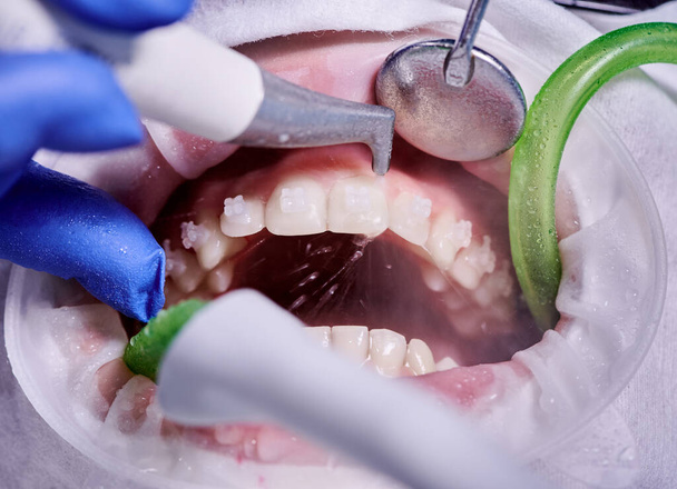 Makrofotografie. Reinigungsprozess im Mund des Patienten mit Wangenrückzieher und Klammern an den Zähnen. Zahnreinigung mit Wasserstrahl und Speichelauswurf. Konzept der professionellen Zahnhygiene - Foto, Bild