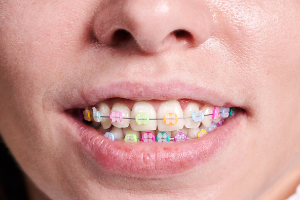 Horizontal close-up snapshot of beautiful woman's smile, demonstrating white healthy teeth with ceramic braces, united with a wire and colorful rubber bands. Front view with a tip of nose - Photo, Image