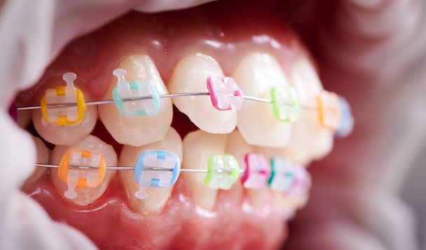 Macro snapshot of dental occlusion, teeth and ceramic braces with colorful rubber bands on them, latex cheek retractor on lips. Concept of dental hygiene - Photo, Image