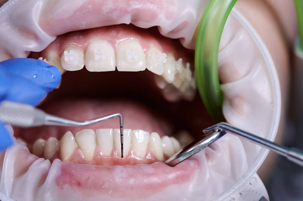 Makro fotoğrafçılık. Hastanın ağzındaki temizlik sürecinin üst görüntüsü. Dişçi dişlerini kontrol etmek için diş aletleri kullanıyor. Dudaklarda yanak retraktörü. Diş hekimliği, sağlık ve ağız sağlığı kavramı. - Fotoğraf, Görsel