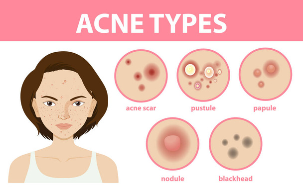 Typy akné na kůži nebo pupínky ilustrace - Vektor, obrázek