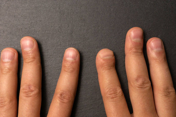 dedos de um jovem sobre um fundo preto. dedo indicador após a cirurgia, nenhuma parte dos dedos - Foto, Imagem