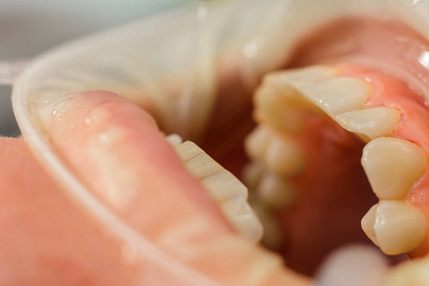 Diş hekimi dişleri matkapla cilalar, dişçi prosedürü ile. Dudak ve diş etlerini ayırmak için bir retraktör. 2020 - Fotoğraf, Görsel